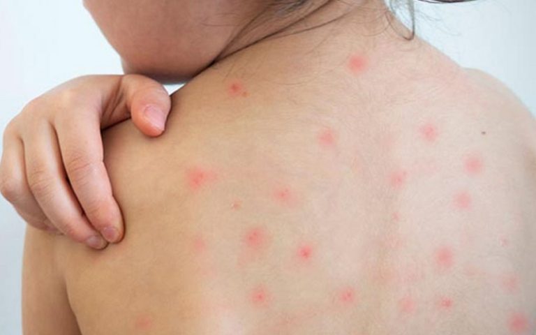 কীভাবে হাম প্রতিরোধ করা যায়?