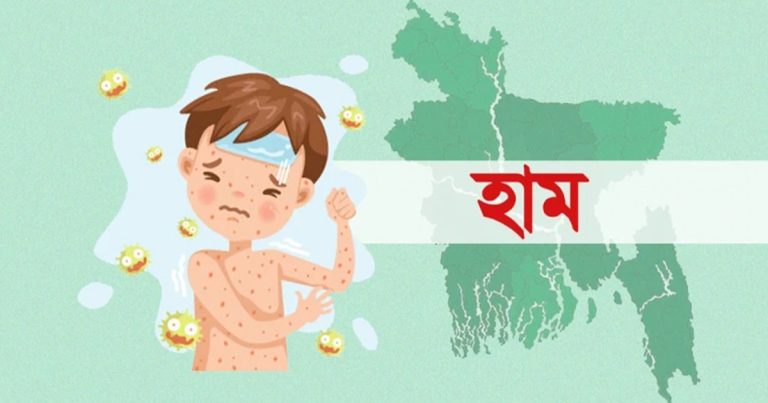 হাম ও উপসর্গে আরও ১২ মৃত্যু, শনাক্ত দেড় হাজার