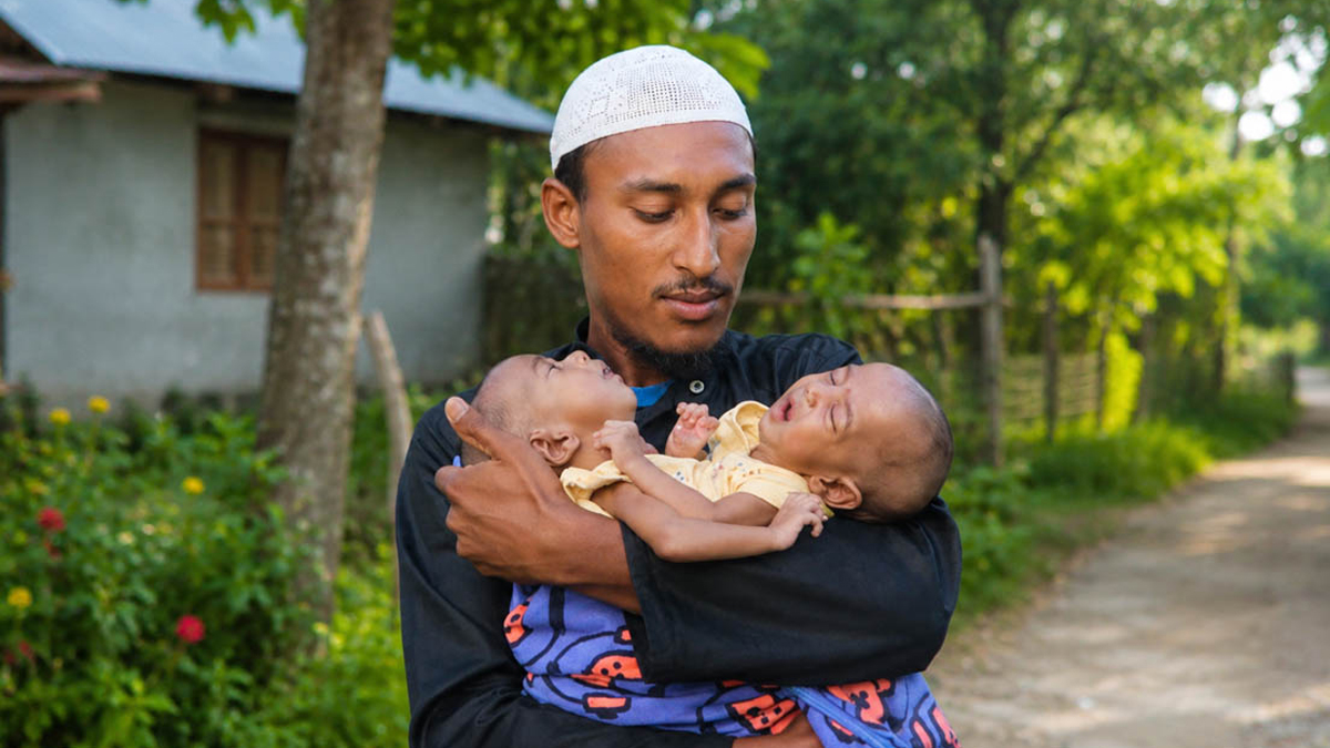 কুষ্টিয়ায় জোড়া লাগানো যমজ শিশুর চিকিৎসা অনিশ্চিত, আর্থিক সংকটে পরিবার